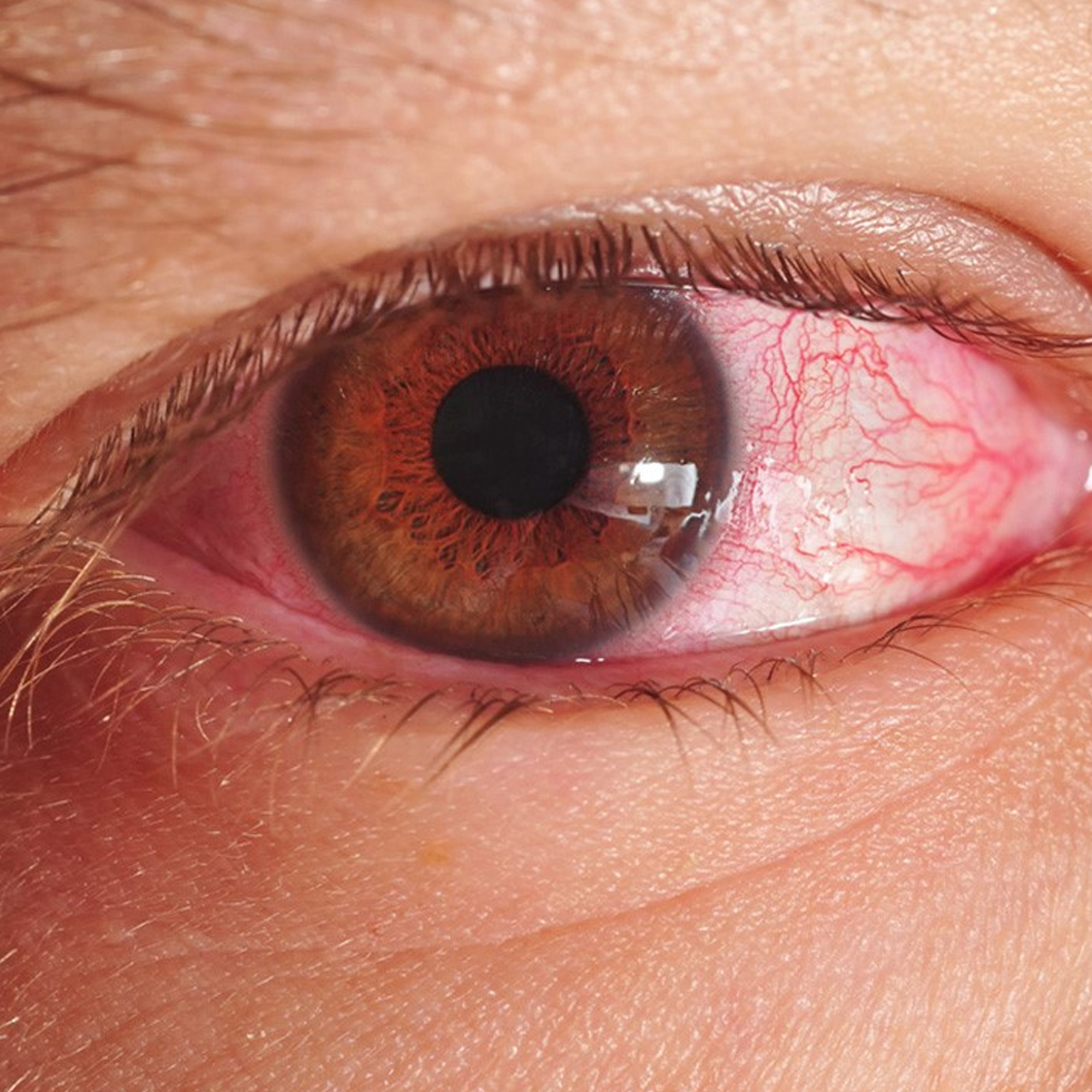 Tips To Avoid Conjunctivitis